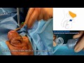 Artificial Urinary Sphincter SURGERY treatment for male severe incontinence