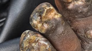 History Of Tunga Penetrans In Kenya - You Can Help