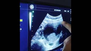 Endometriozisden gelişen yumurtalık kanseri ultrasonografi görünümü