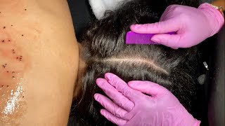 Hydrating Back Facial Treatment W Scalp Scratching & Mage Asmr For Sleep
