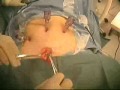 Colon Surgery