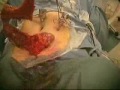Colon Surgery