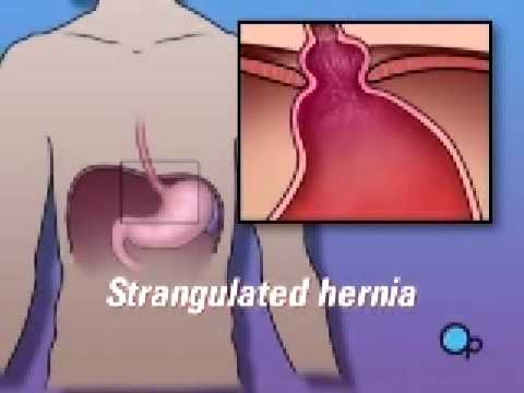 Hiatal Hernia X Ray. Malpractice Medical Hernia