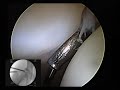 Large Hip Labral Repair