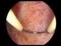Hsk Septum Rah M Perdes images Hsk Septum Rah M Perdes