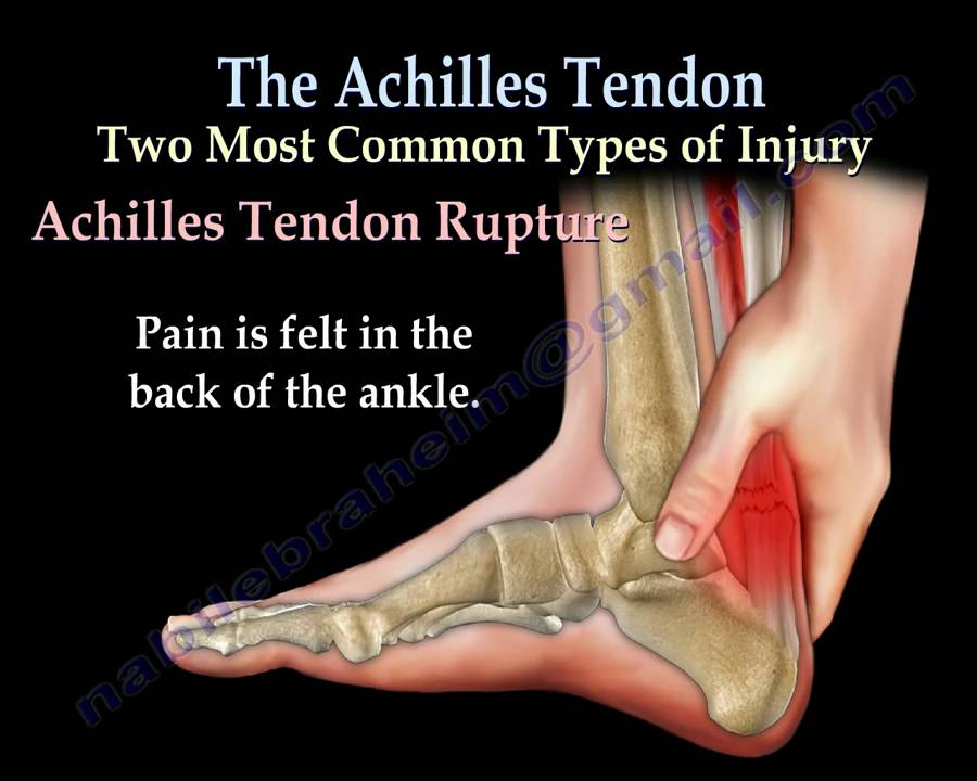 Achilles Tendon rupture ,tear, tendonitis - Everything You Need To Know