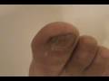 heal cracked heals nail fungus