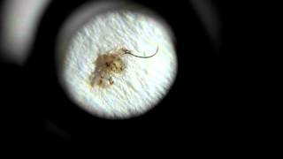 Pubic Lice, Pthirus Pubis Crab Louse 阴虱 陰蝨 ケジラミ