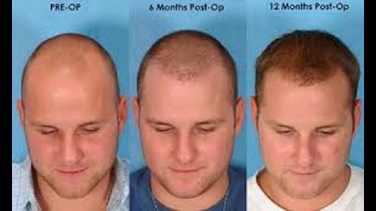 Facial hair growing enhancement