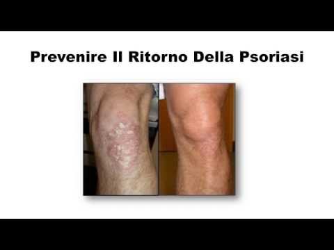 Guarire un fungo tra le dita