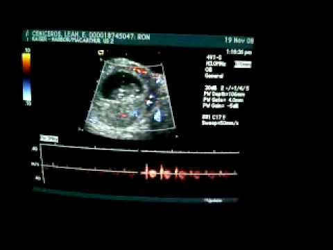 12 5 week ultrasound. 9 Week UltraSound. 0:12
