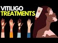 Doctor explains VITILIGO TREATMENT OPTIONS | Phototherapy, excimer laser, steroids & more