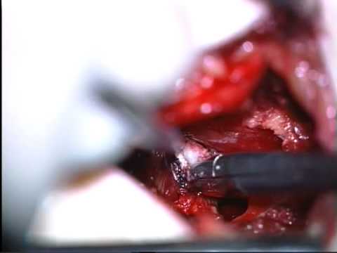 bergman kliniek hernia operatie