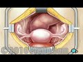 Hysterectomy Removal of the Uterus PreOp® Patient Education Feature