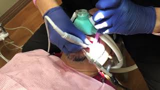 A~flexX being used with an HVE on a patient with large pieces of tarter! Great video!! Thank You!