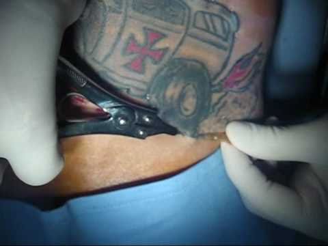 7:00 タトゥー切縫前処置例 Pretreatment of Excision Tattoo Removal; 