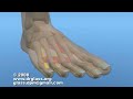 Morton's Neuroma Pain in Foot - Surgical Excision