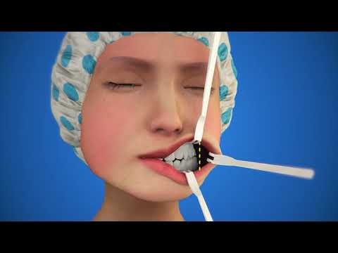 Phẫu thuật gọt mặt V Line 3D "Vẽ Lại Cuộc Đời" đẹp đến từng Milimet