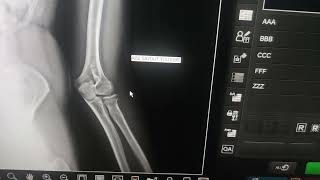 Dirsek Grafisi Radyolojik Anatomi Dirsek Grafik Görüntüsü Nasıl? Radyolojik Anatomi Dersi