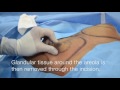 Gynecomastia Surgery | Male Breast Reduction