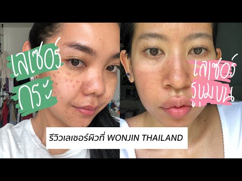 REVIEW l เลเซอร์กระและรูขุมขนที่ Wonjin Thailand