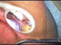 DR. GERARD CUOMO - Implant Dentistry - Straumann NC BL open tray transfer abutment 3 - Florida