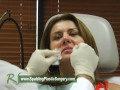 Get Rid Of Smile Lines With Restylane!