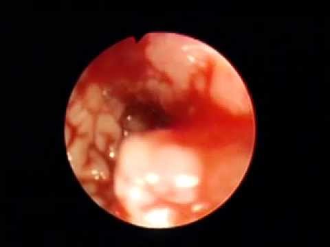 tumor bleeding sigmoid colon cancer tumor bleeding sigmoid colon cancer