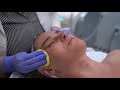 RF (Radiofrequency) Microneedling - Bonnie Brenkman, Medical Aesthetician | West End Plastic Surgery