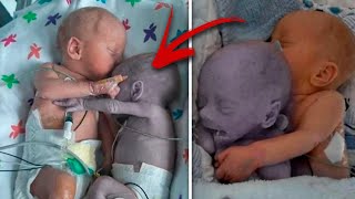 Mom puts the baby to the dying Twin and five minutes later a real Miracle happen