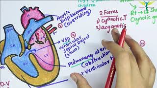 Tetralogy Of Fallot Tof