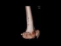 DFO (Distal femur osteotomy) Nha Kw #4 DFO (Distal femur osteotomy) Nha Kw #4