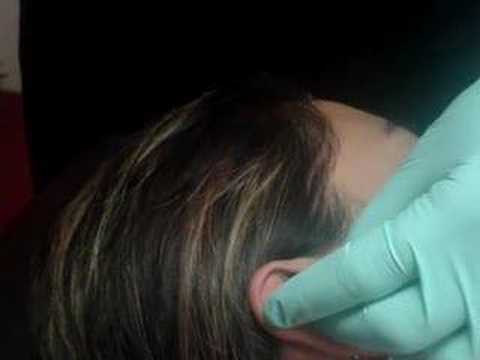 Rook (piercing) Video fourchette piercing. Rook (piercing) Video