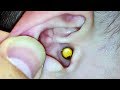 Worst Ear Problems Redux