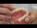 Jak D Ugo Trwa Wstawianie Implantu Z Ba Jak D Ugo Trwa Wstawianie Implantu Z Ba