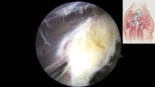 Coracoid fracture treated a Latarjet Procedure