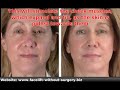 Lose Face Fat With Chubby Cheek Exercises To Lift Sagging images Lose Face Fat With Chubby Cheek Exercises To Lift Sagging