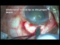 Manual Small Incision Cataract Surgery MSICS (SICS) - Dr.S.Ma (Case ID 123007)