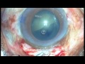 Manual Small Incision Cataract Surgery Msics Sics Dr S Ma images Manual Small Incision Cataract Surgery Msics Sics Dr S Ma