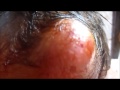 Forehead Abscess