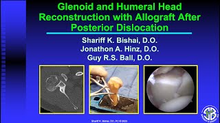 Glenoid and Humeral Head Reconstruction with Allograft After Posterior Glenohumeral Dislocation