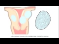 Fibroid in Uterus (Myoma) : What is a Fibroid, Causes, Types, Symptoms and Fibroid Treatment.