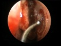 Chirurgia endoscopica nasale