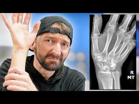 I broke my wrist.