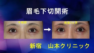 目元のたるみ改善法☆ 新宿 山本クリニック