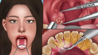 Asmr Tonsil Stone Removal Animation. Asmr Treatment Animation By Ksenia