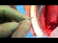 Virtue Male Sling performed by Eugene Rhee, MD