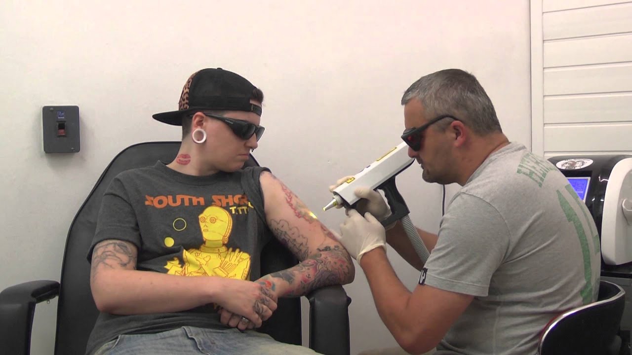 Tattoo Removal in North East Lincolnshire - YouTube