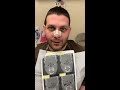 Septorhinoplasty/Sinus Surgery 7 days ago
