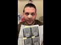 Septorhinoplasty/Sinus Surgery 7 days ago